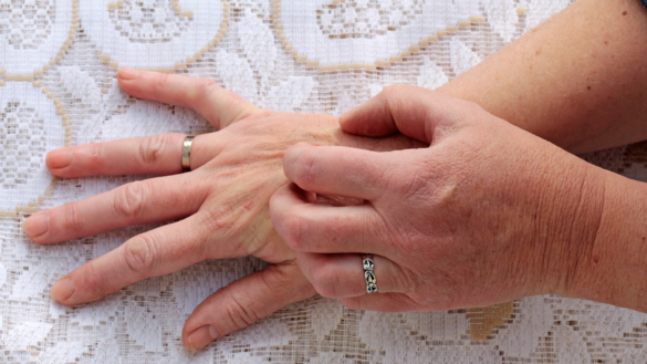 Torr hud och klåda – långvarig klåda hos äldre ett bekymmer